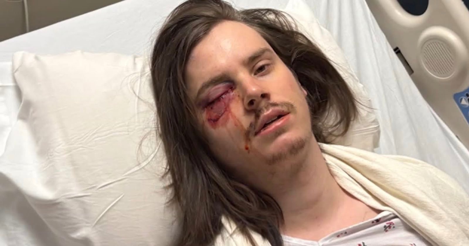 Another Photographer Struck by Rubber Bullets During LA Protests, This Time in the Eye Another Photographer Struck by Rubber Bullets During LA Protests, This Time in the Eye